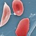 دواء أميركي جديد يبشر بالأمل في علاج مرض خلايا الدم المنجلية 5 blood