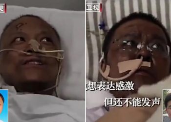 أعراض جديدة.. فيروس كورونا يغير لون جلد ناجيين ويؤثر على الدماغ